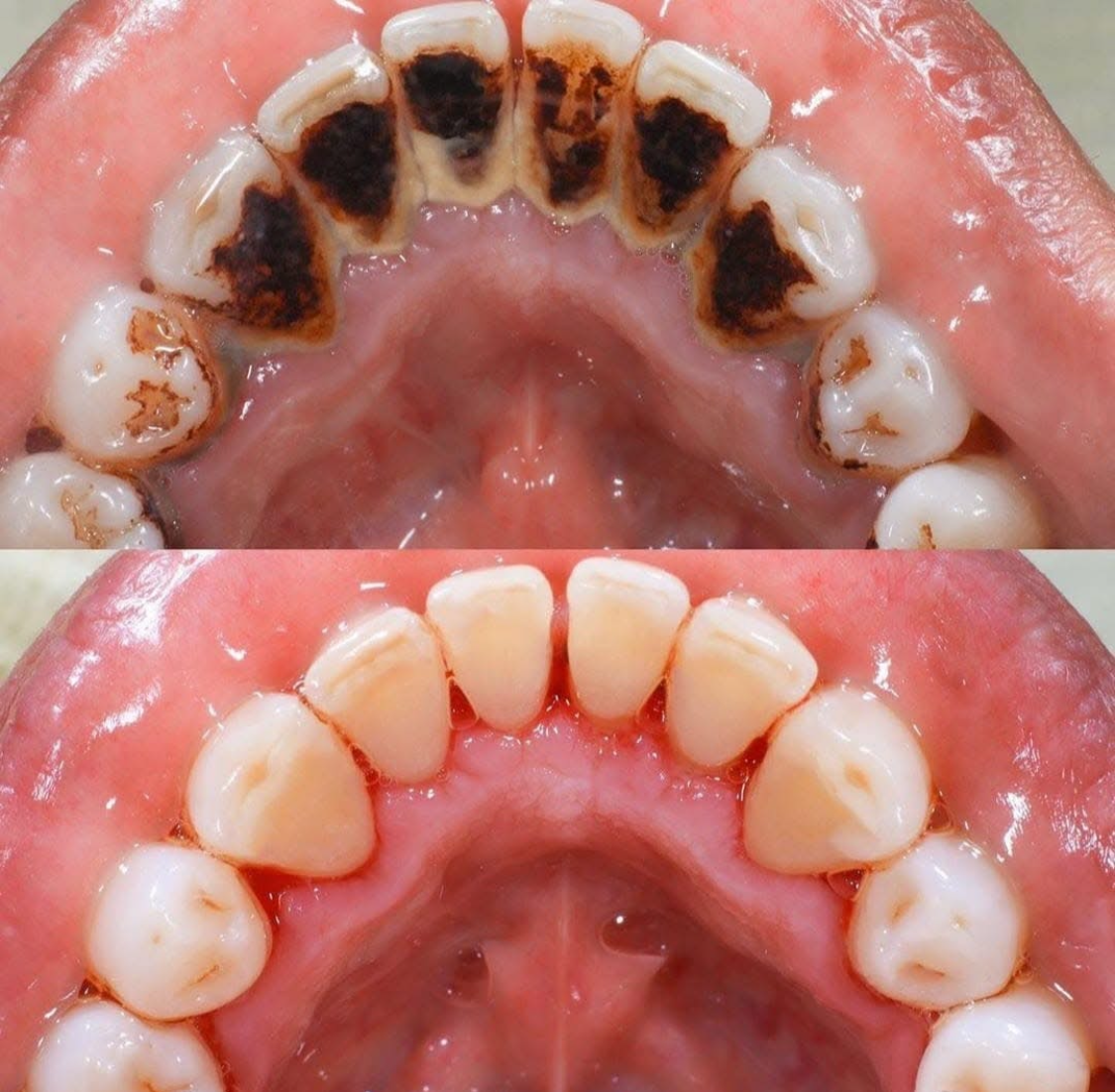 Antes y después — Remoción de Sarro