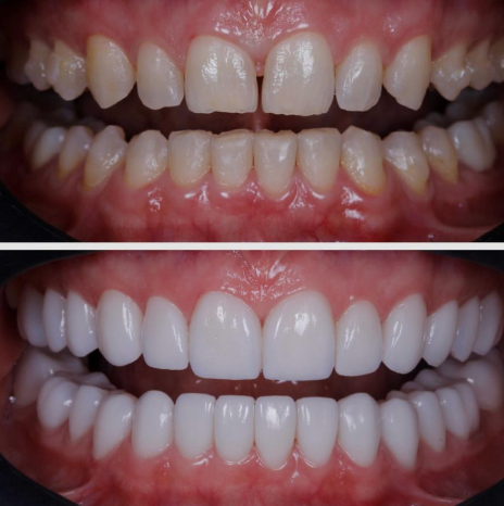 Antes y después — Diseño de Sonrisa