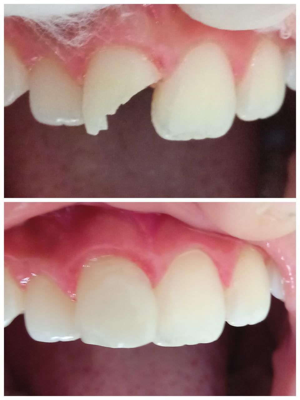 Antes y después — Carilla de Porcelana