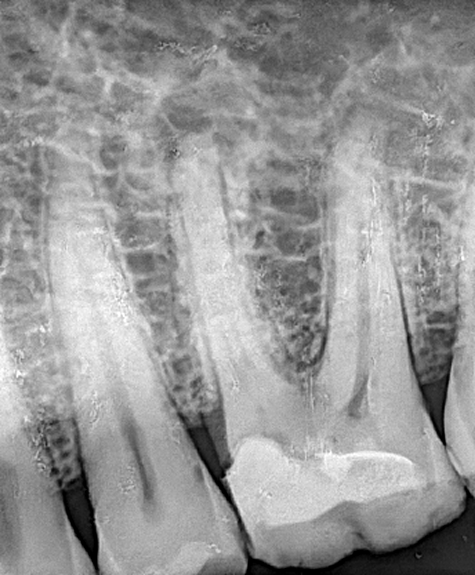 Radiografía periapical dental